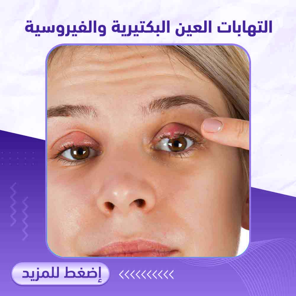 التهابات العين - صيدلية برلين 