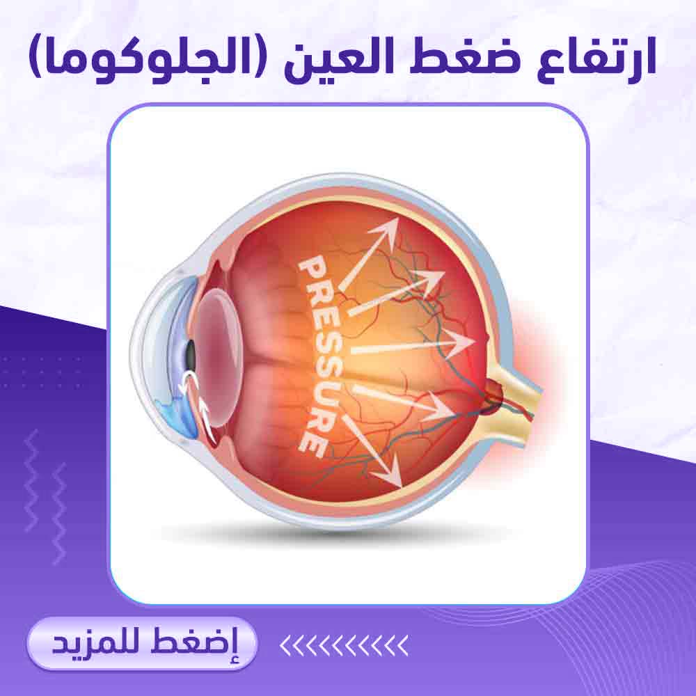 ارتفاع ضغط العين - صيدلية برلين