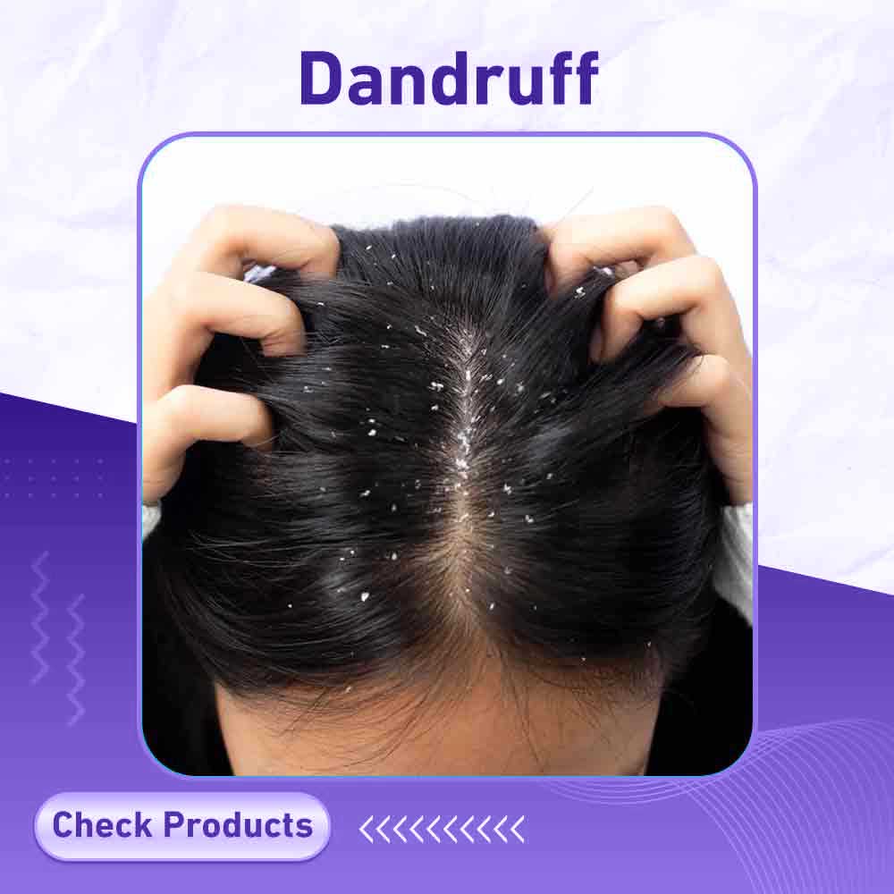 dandruff - Berlin Pharmacy