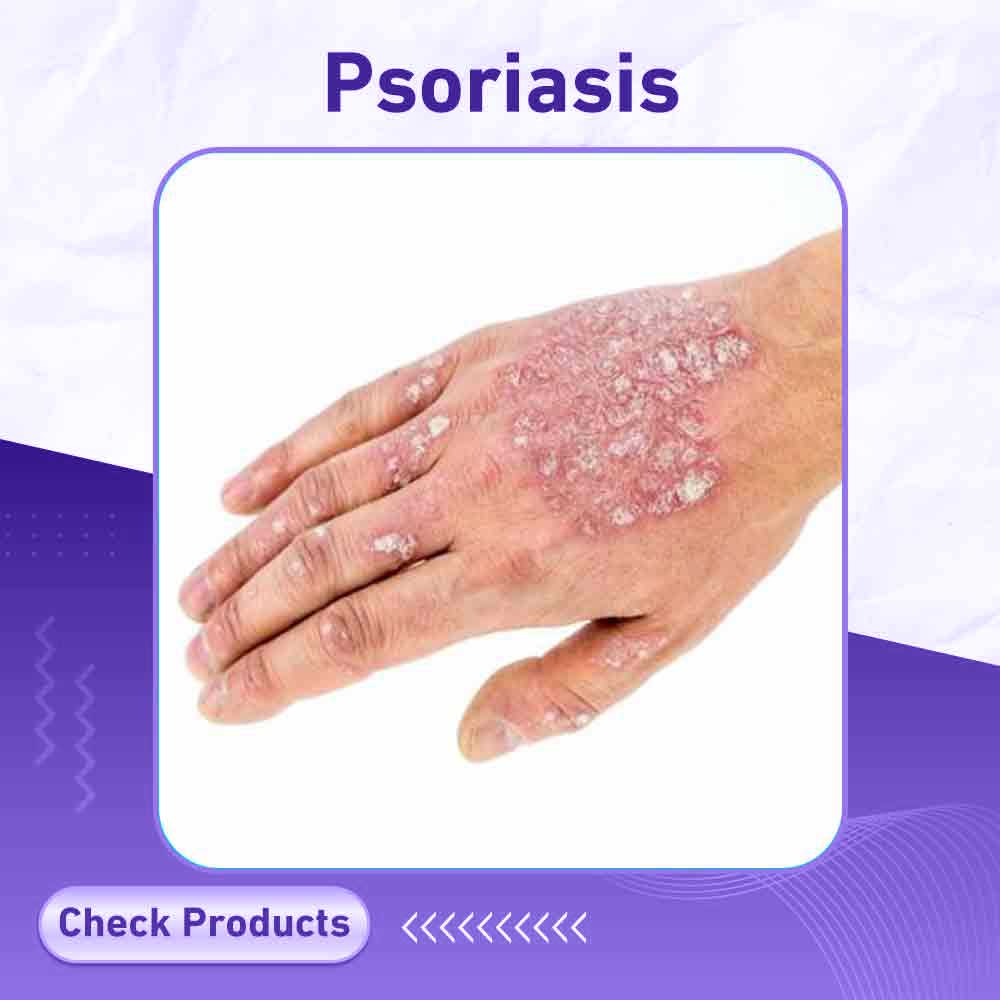 psoriasis - Berlin Pharmacy