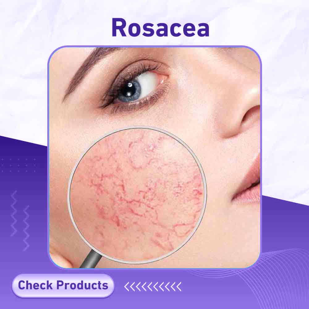 rosacea - Berlin Pharmacy