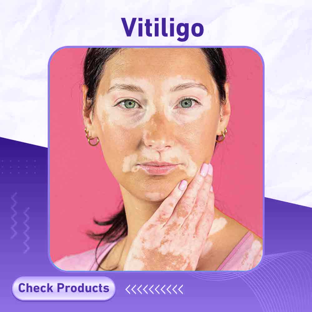 vitiligo - Berlin Pharmacy