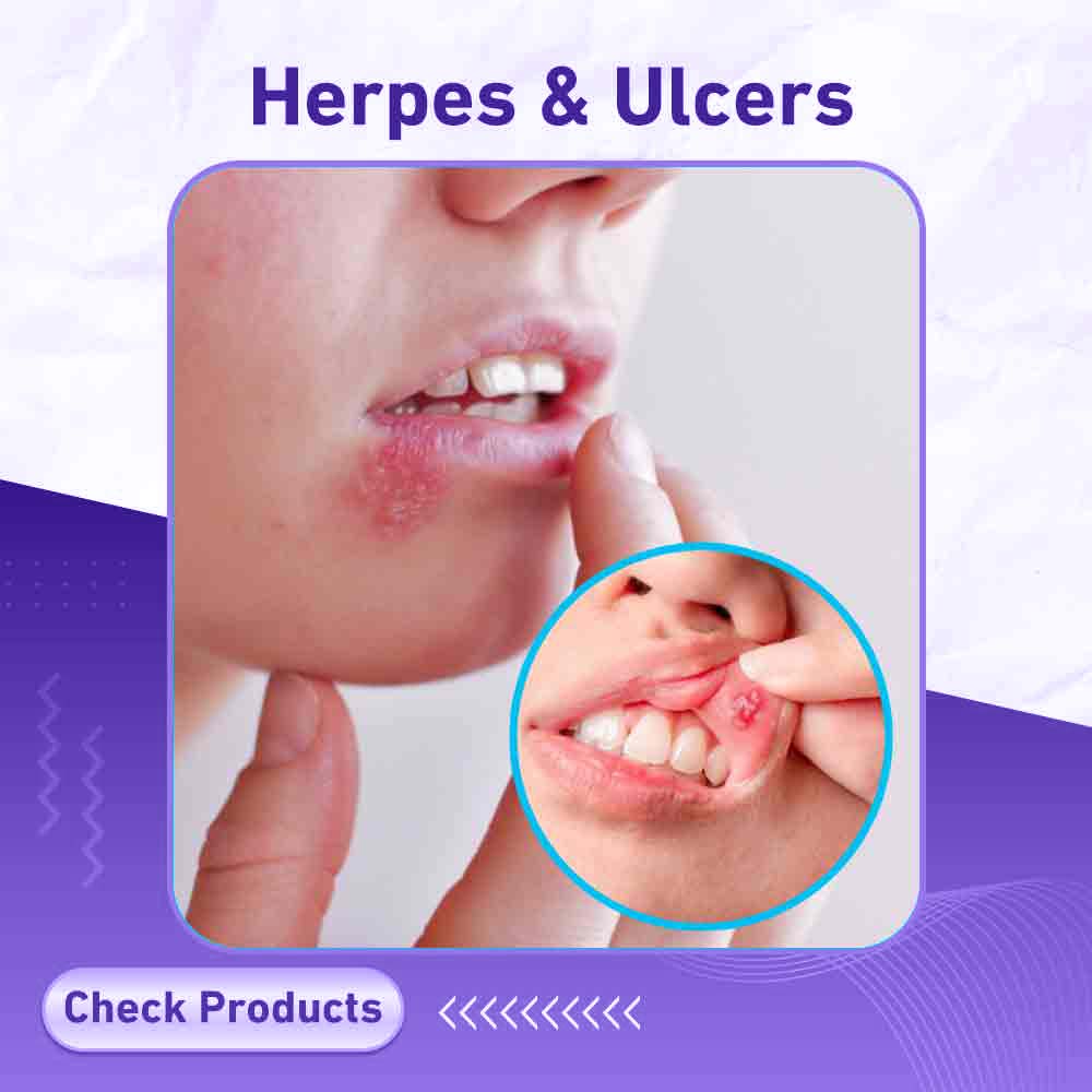 Herpes & Ulcers - Berlin Pharmacy