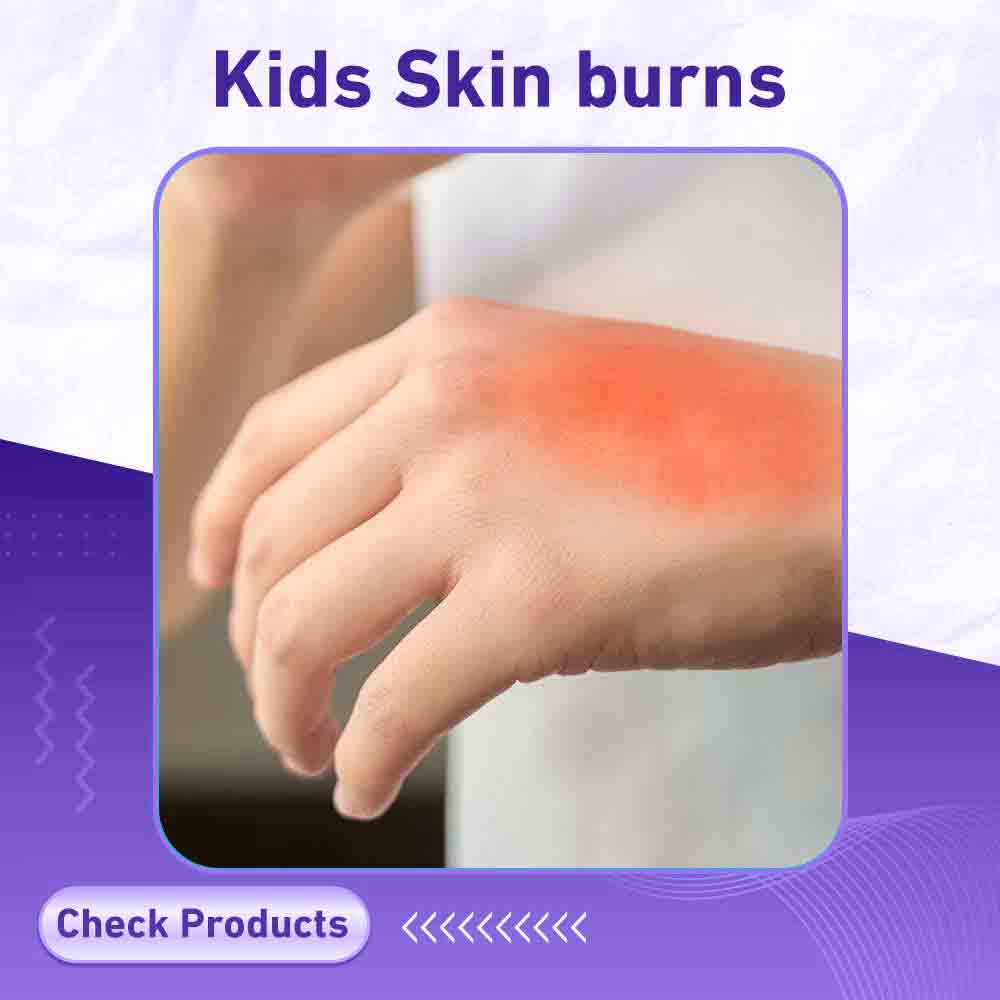 Kids Skin burns - Berlin Pharmacy