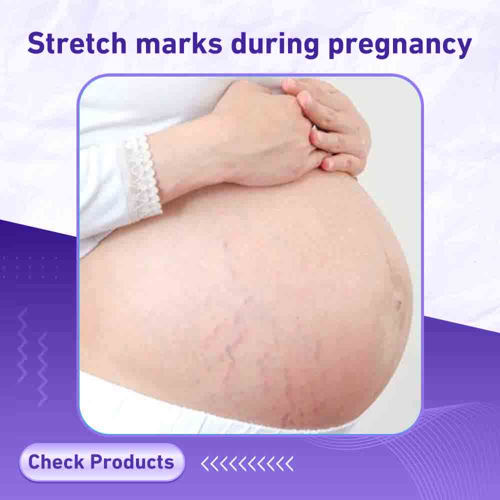 Stretch marks during pregnancy - Berlin Pharmacy