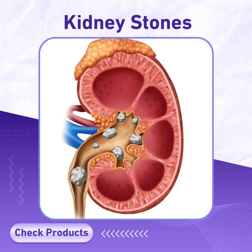 Kidney Stones - Berlin Pharmacy